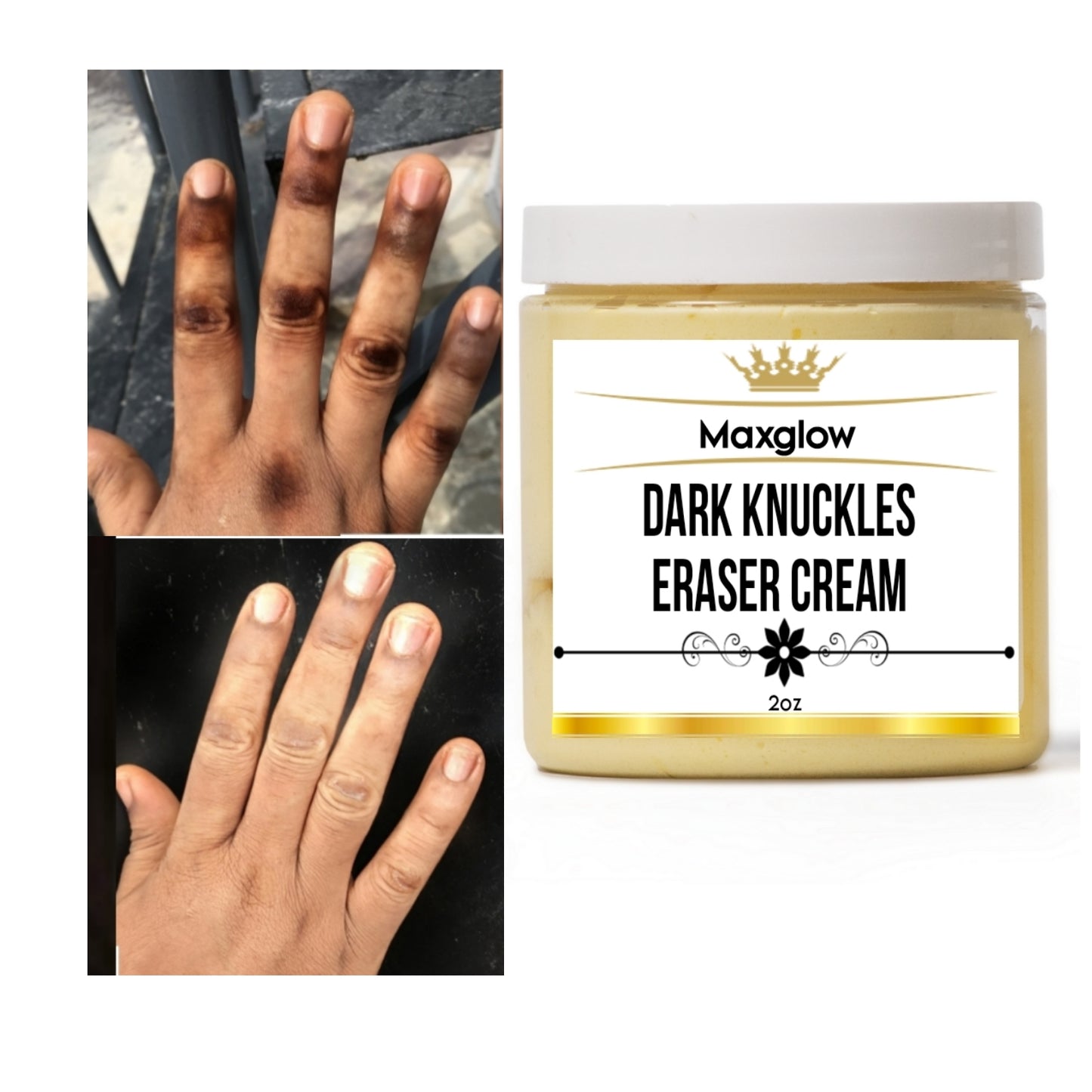 Dark knuckles  Eraser cream , Knuckles pots remover